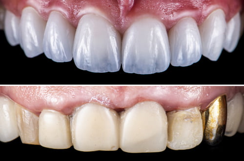 all on 4 before after full arch restoration results