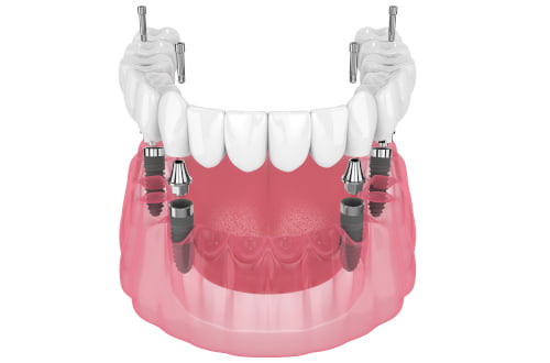 all on 4 candidate jawbone implant planning 3d
