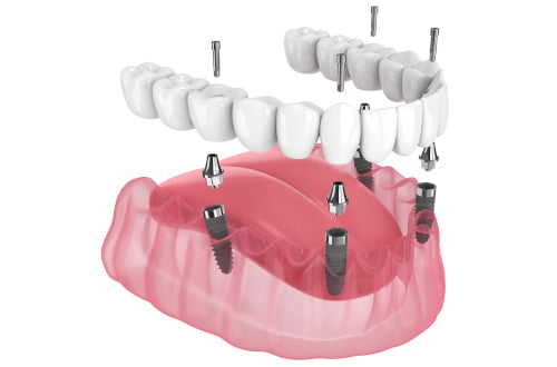 all on 4 dental implants, full arch fixed bridge pickering