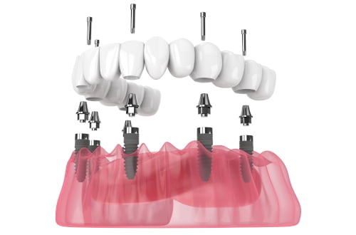 all on 4 implants long term durability full arch