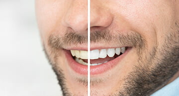 When should I consider whitening my teeth?