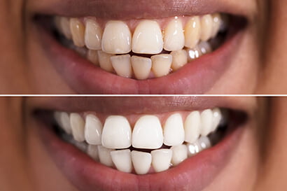 How Long Do Whitening Results Last?