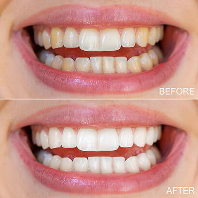 How White Will My Teeth Get?