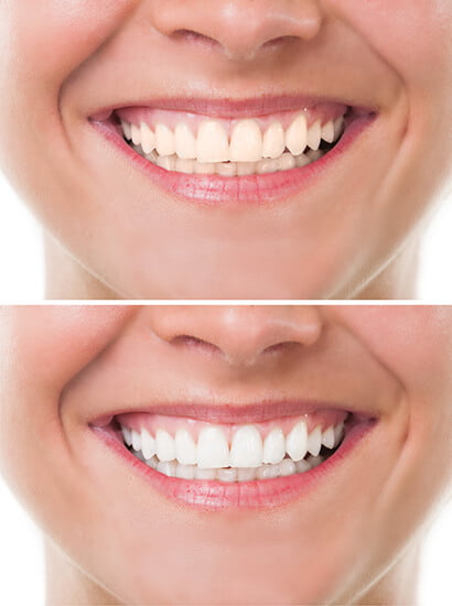 Is Teeth Whitening Safe?