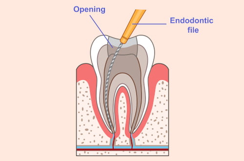 root canal process cleaning canals sealing infection removal