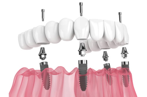 Teeth in a Day fixed temporary bridge on dental implants in Pickering