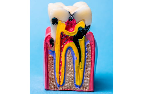 untreated tooth infection spread bone damage root canal delay