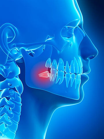 Wisdom teeth illustration showing jaw and third molars