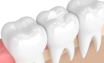 white non metal fillings