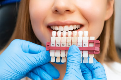 Dental veneer shade guide used to evaluate a patient's suitability for porcelain veneers and achieve a natural-looking smile.
