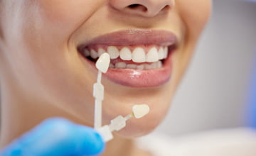 What are Porcelain Veneers