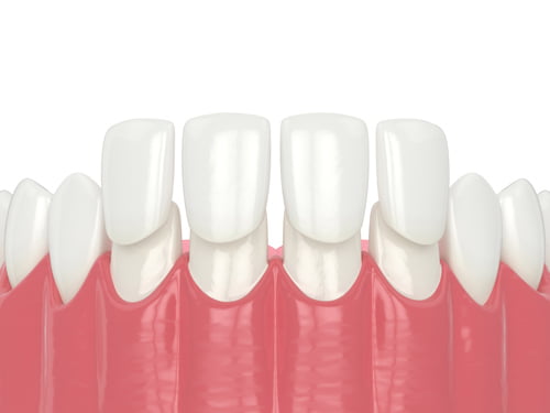 3D illustration showing porcelain veneers placed on front teeth to improve the appearance of a smile.