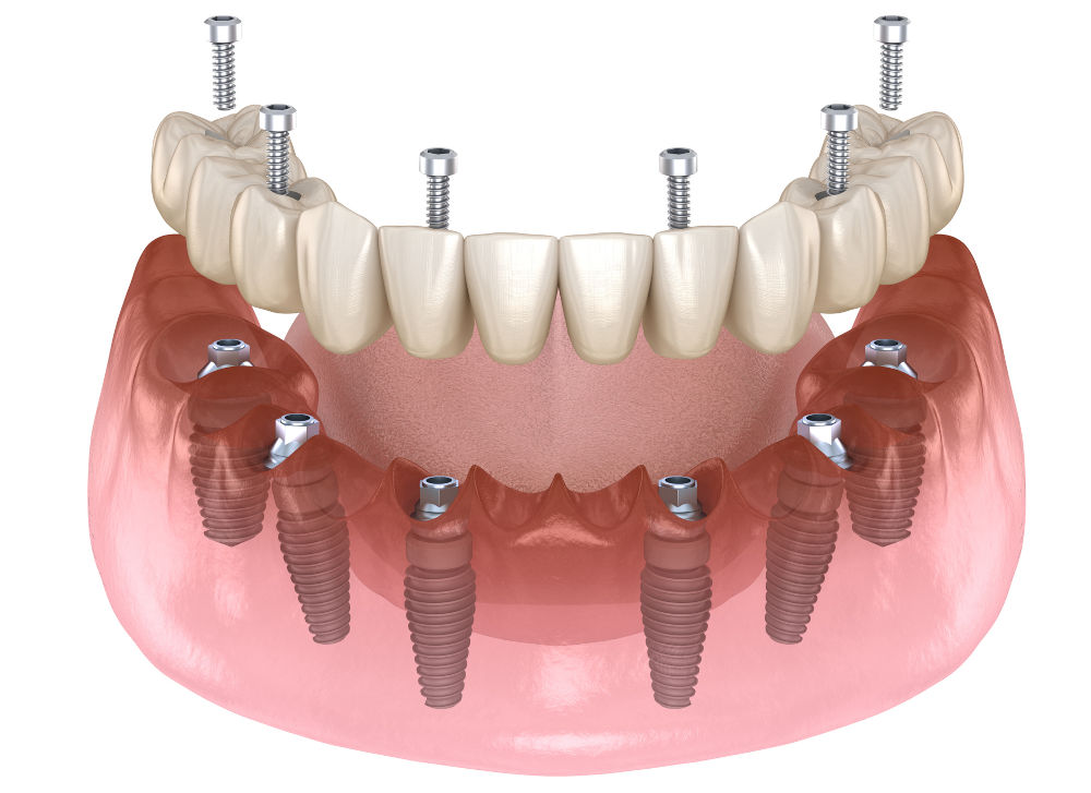 All-on-X Dental Implants in Pickering: Full Arch Teeth in a Day with Digital Planning