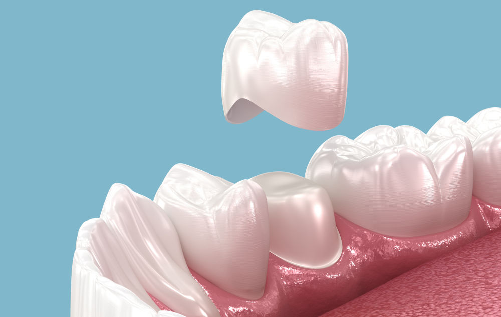 Full Mouth Restoration with Porcelain Crowns: Types, Procedure, and What to Expect