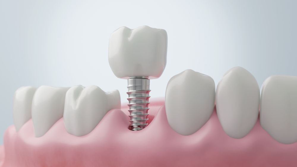 How Long Do Dental Implants Last?