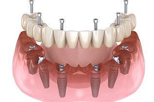 All-on-X Dental Implants in Pickering: Full Arch Teeth in a Day with Digital Planning