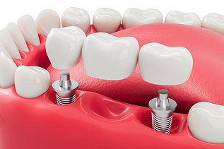 Dental Bridge vs Implant: Which Is the Right Choice for You in Ontario?