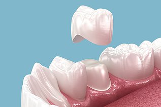 How Much Does a Dental Crown Cost in Ontario?