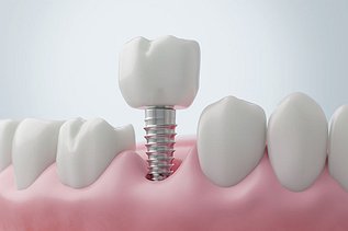 How Long Do Dental Implants Last?