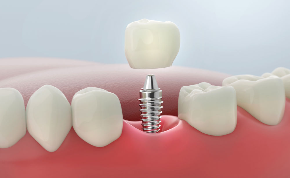 Single dental implant showing implant post, abutment, and crown for Ontario patients