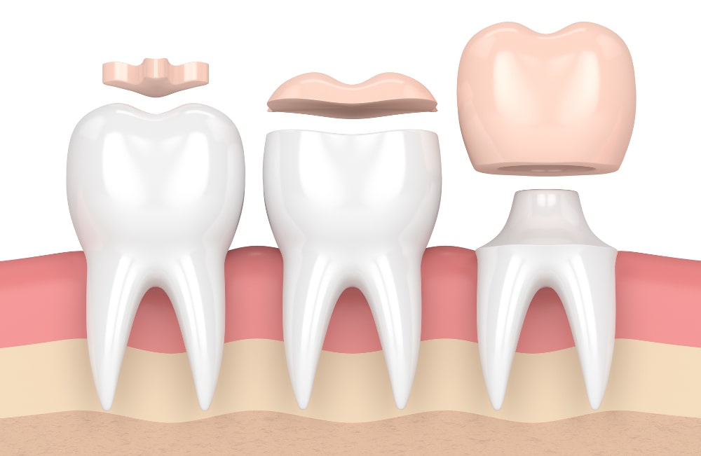 3D render showing different types of dental crowns on teeth